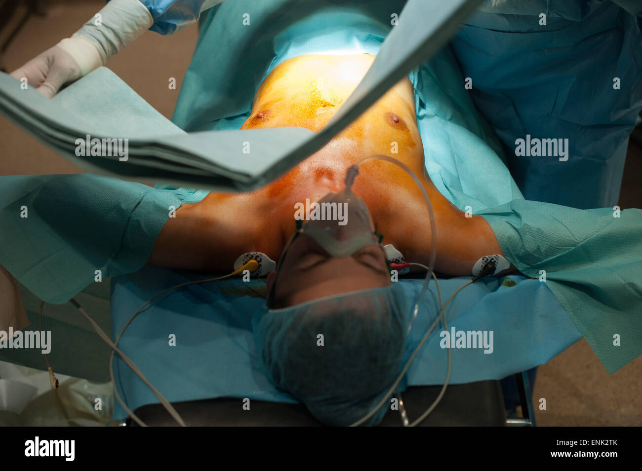 Plastische Chirurgie auf der Brust Stockfoto