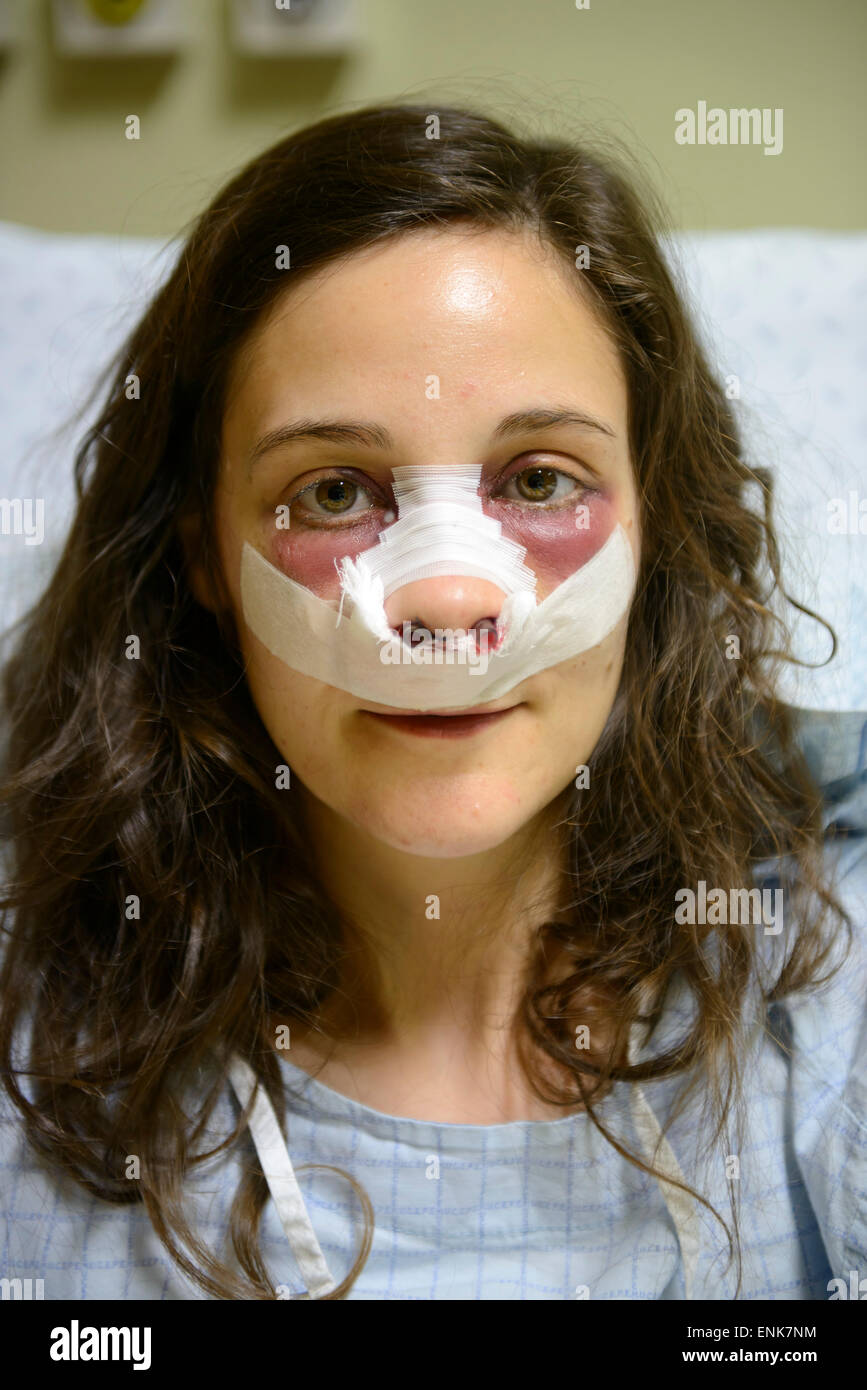 Junge Frau mit Bandagen auf Gesicht während der Genesung von einer Nasenkorrektur (Rhinoplastik) in einem Krankenhausbett Stockfoto