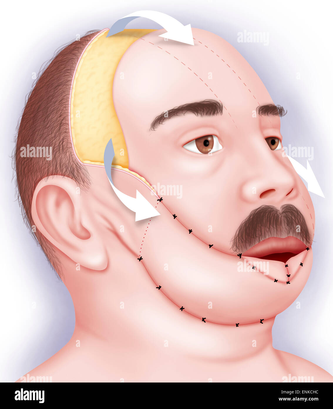 Plastische Gesichtschirurgie Stockfoto