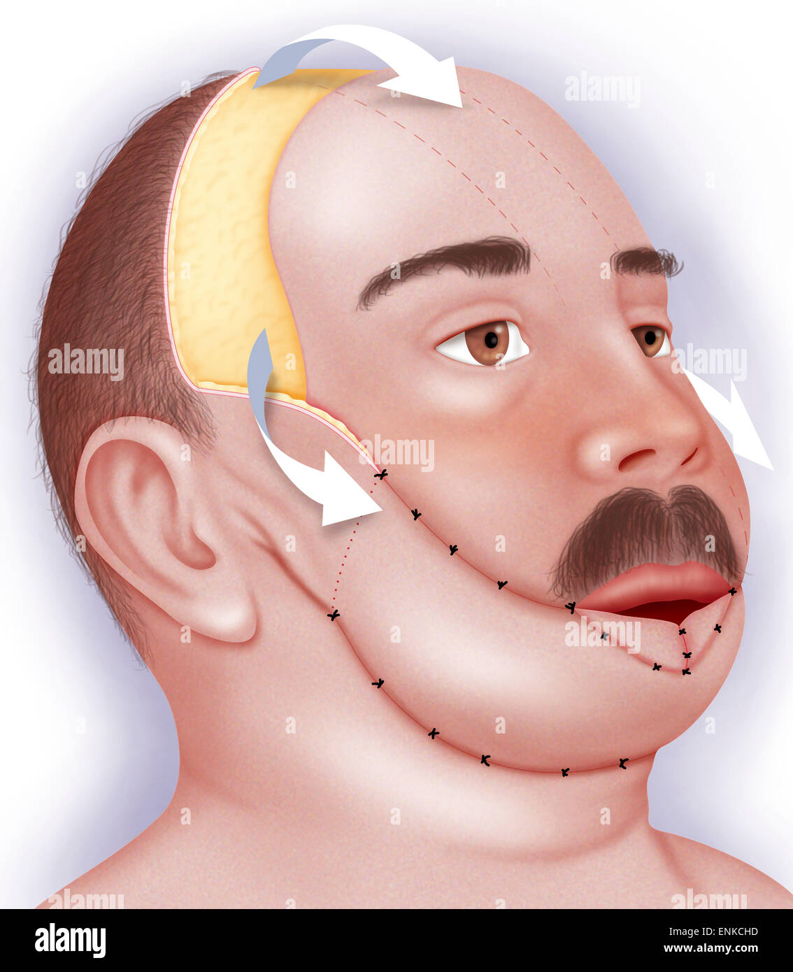 Plastische Gesichtschirurgie Stockfoto