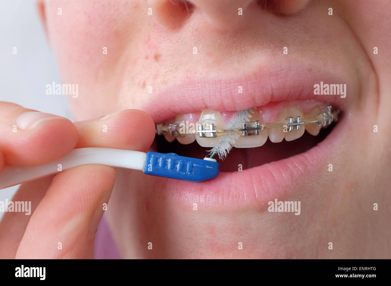 Teenager, die Reinigung seiner Zähne und Klammern mit einem Pinsel hautnah Stockfoto