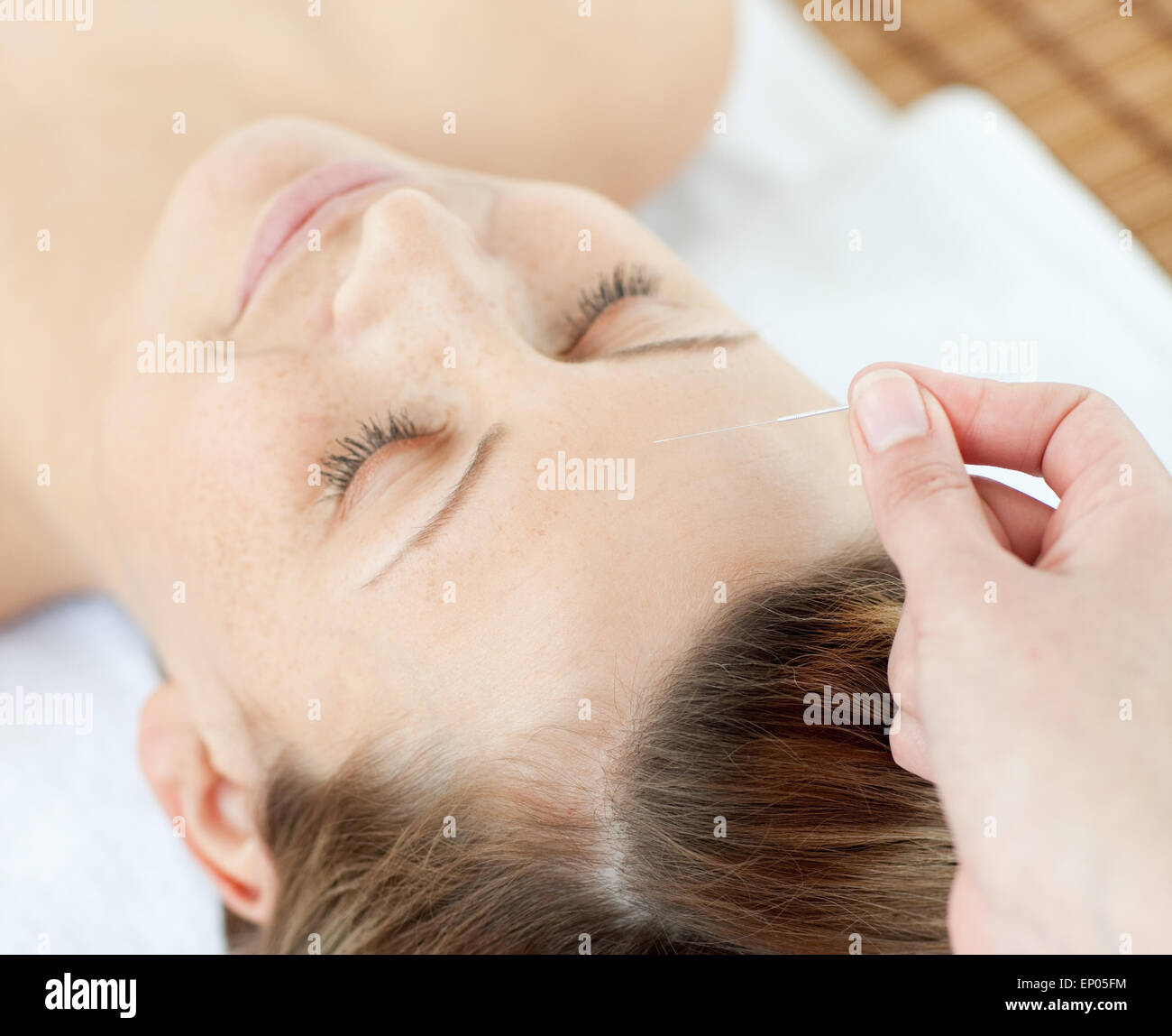 Akupunkturnadeln auf eine attraktive Frau Kopf Stockfoto