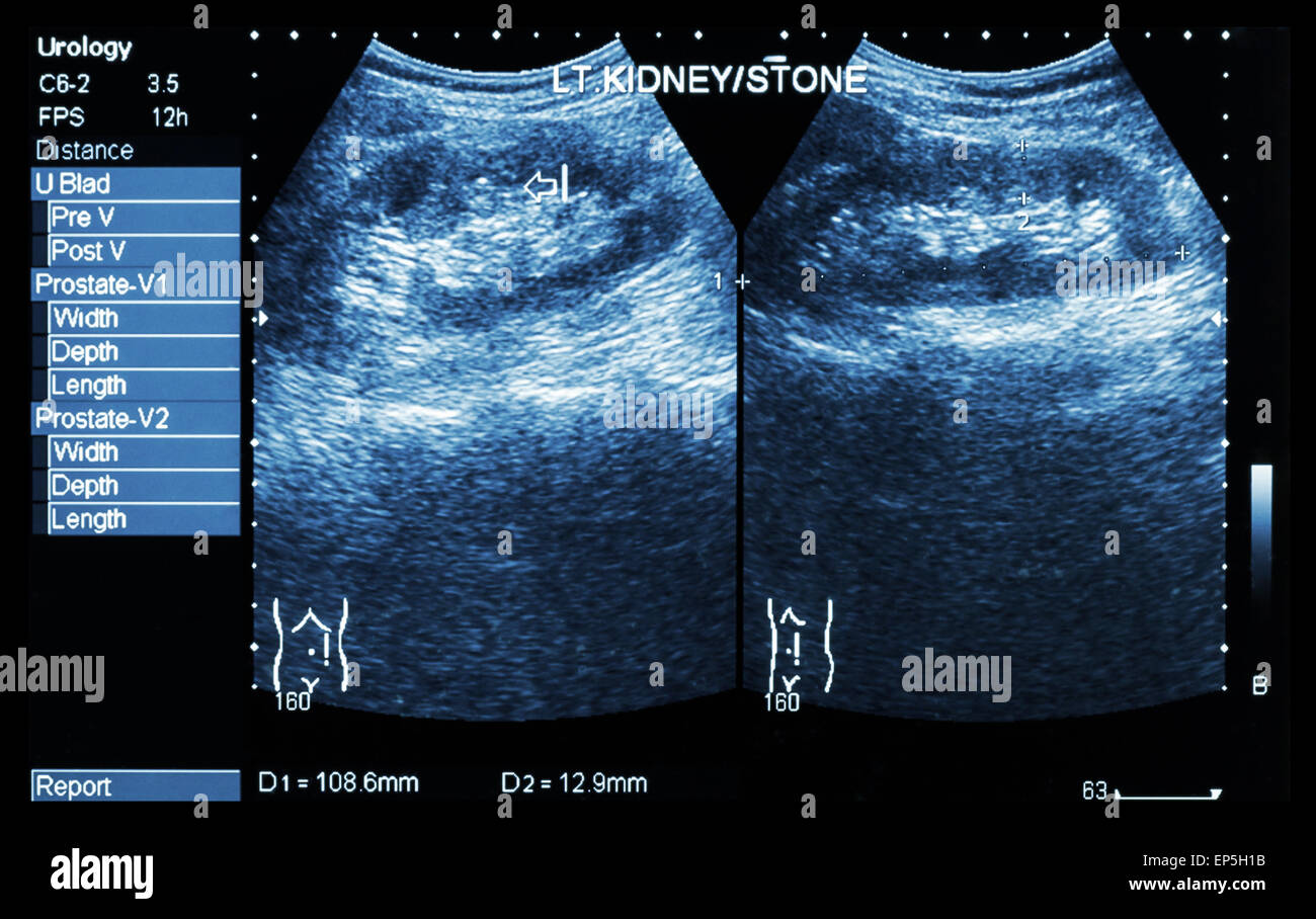 Sonographie der Niere: verließ Show Nierenstein (2 Bilder vergleichen) Stockfoto