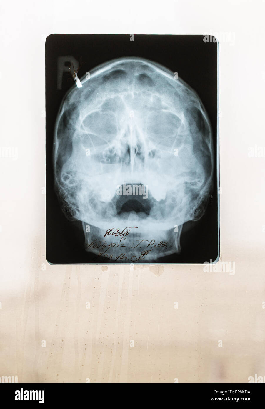 Nahaufnahme von einem Childs Schädel Röntgen an einem nebligen Fenster Stockfoto