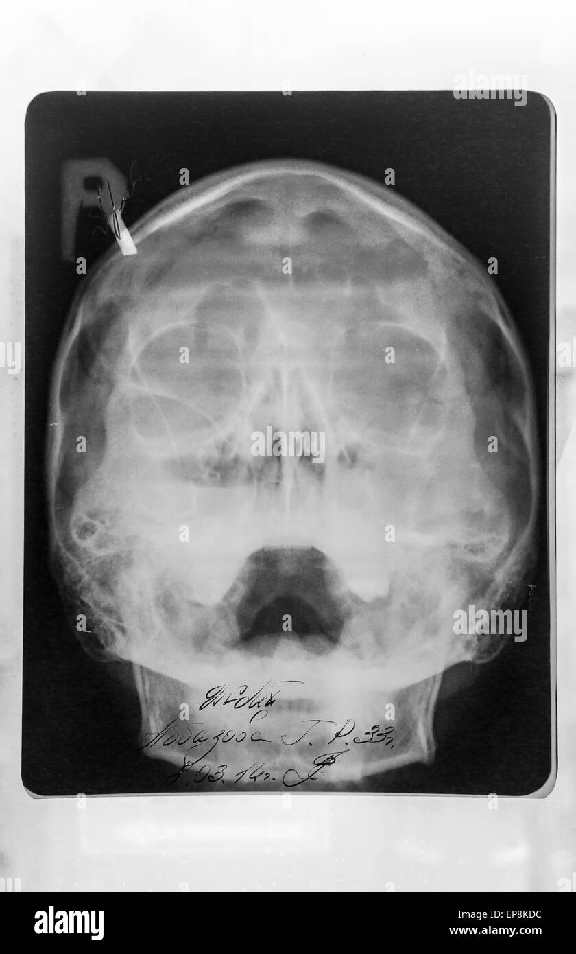 Nahaufnahme von einem Childs Schädel Röntgen in schwarz / weiß Stockfoto
