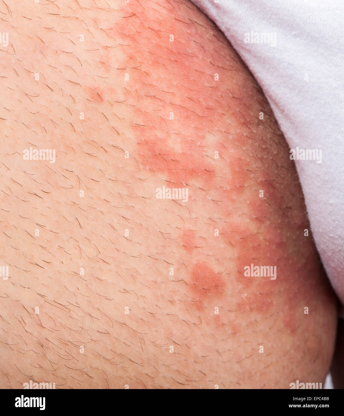 Ekzem Leistengegend atopischer Dermatitis Symptom der Hautstruktur Stockfoto