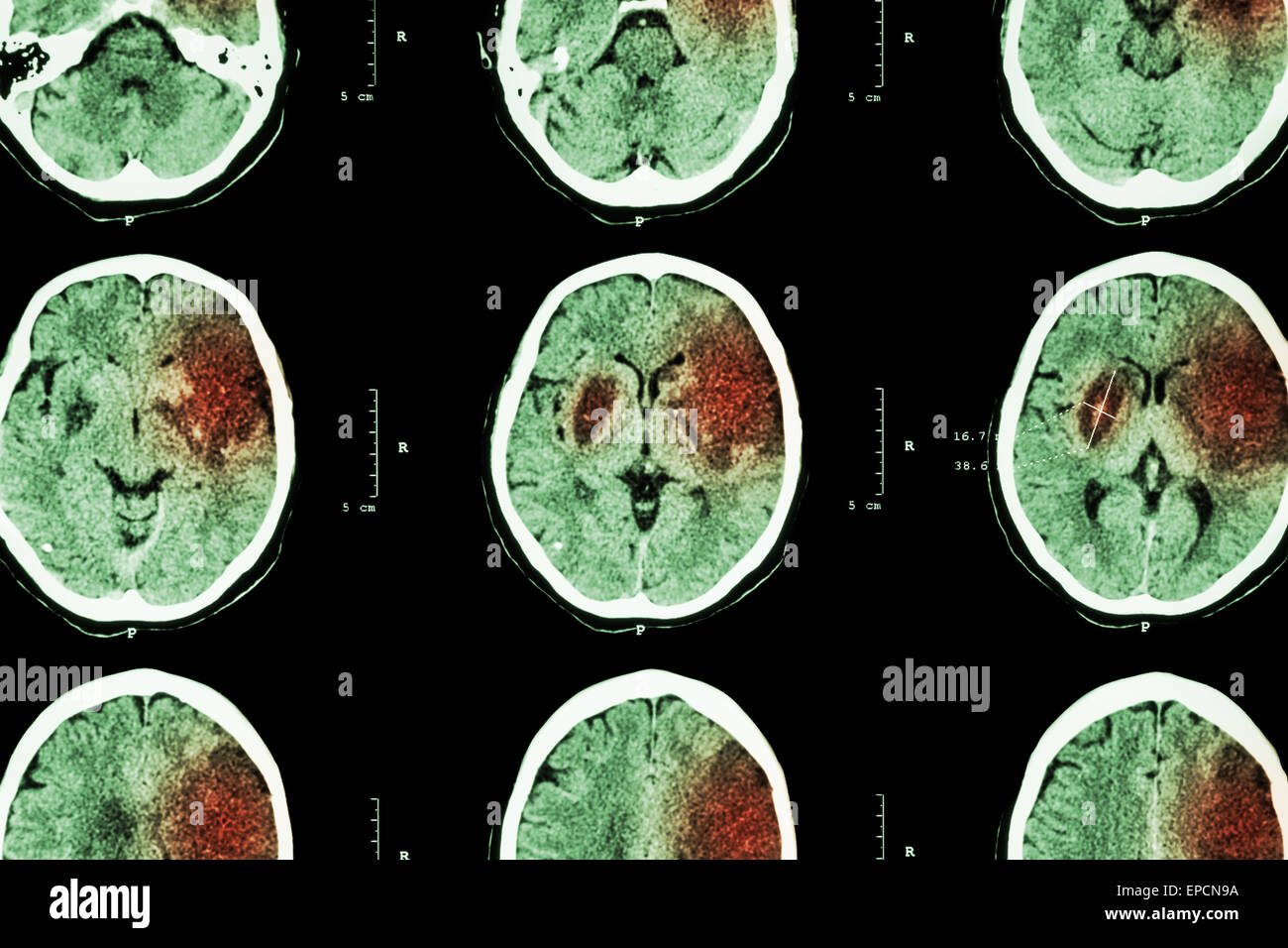 Ischämischen Schlaganfall: (CT des Gehirns zeigen Hirninfarkt im linken Frontallappen - temporal - Parietallappen) (Nervensystem Zeitmessung Stockfoto