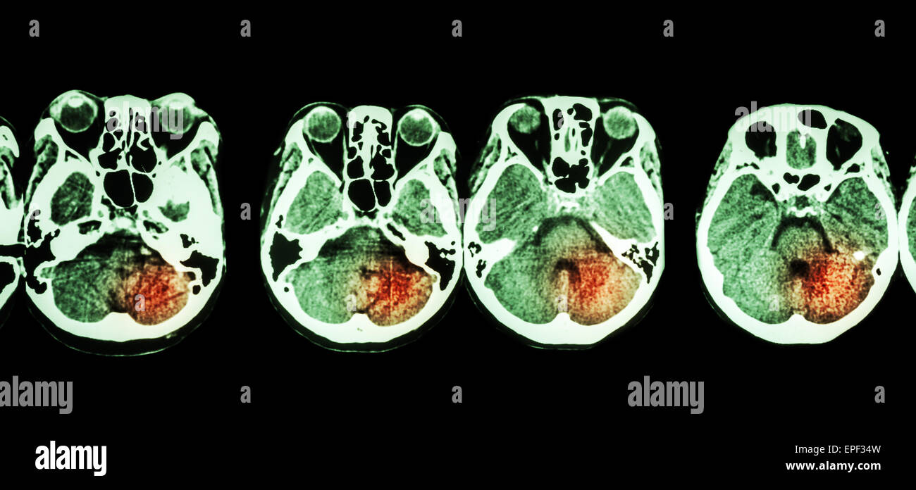 Schlaganfall (CT-Scan des Gehirns) und Basis des Schädels und Schlaganfall Stockfoto