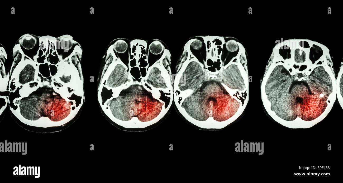 Schlaganfall (CT-Scan des Gehirns) und Basis des Schädels und Schlaganfall Stockfoto