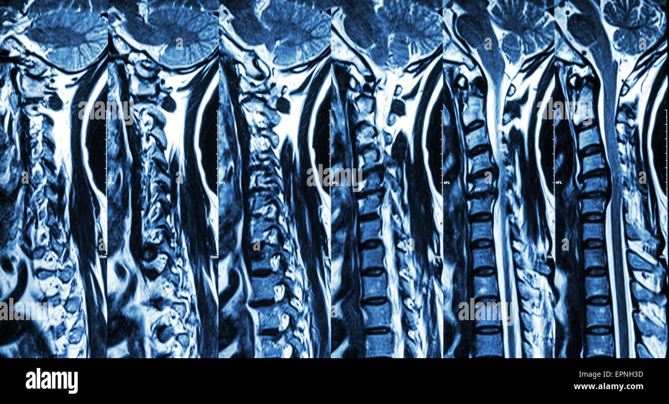 Zervikale Spondylose mit Bandscheibenvorfall (MRT der Halswirbelsäule: Show zervikale Spondylose mit Bandscheibenvorfall komprimieren Spin Stockfoto