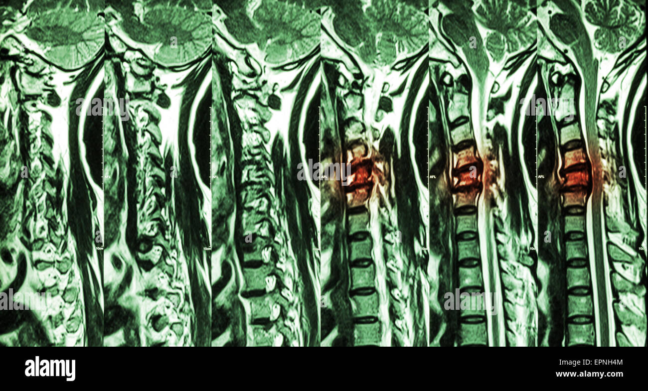 Zervikale Spondylose mit Bandscheibenvorfall (MRT der Halswirbelsäule: Show zervikale Spondylose mit Bandscheibenvorfall komprimieren Spin Stockfoto