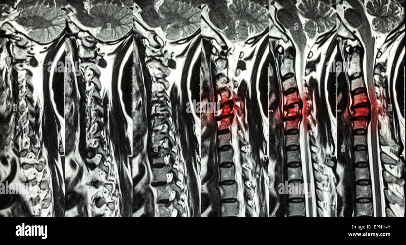 Zervikale Spondylose mit Bandscheibenvorfall (MRT der Halswirbelsäule: Show zervikale Spondylose mit Bandscheibenvorfall komprimieren Spin Stockfoto