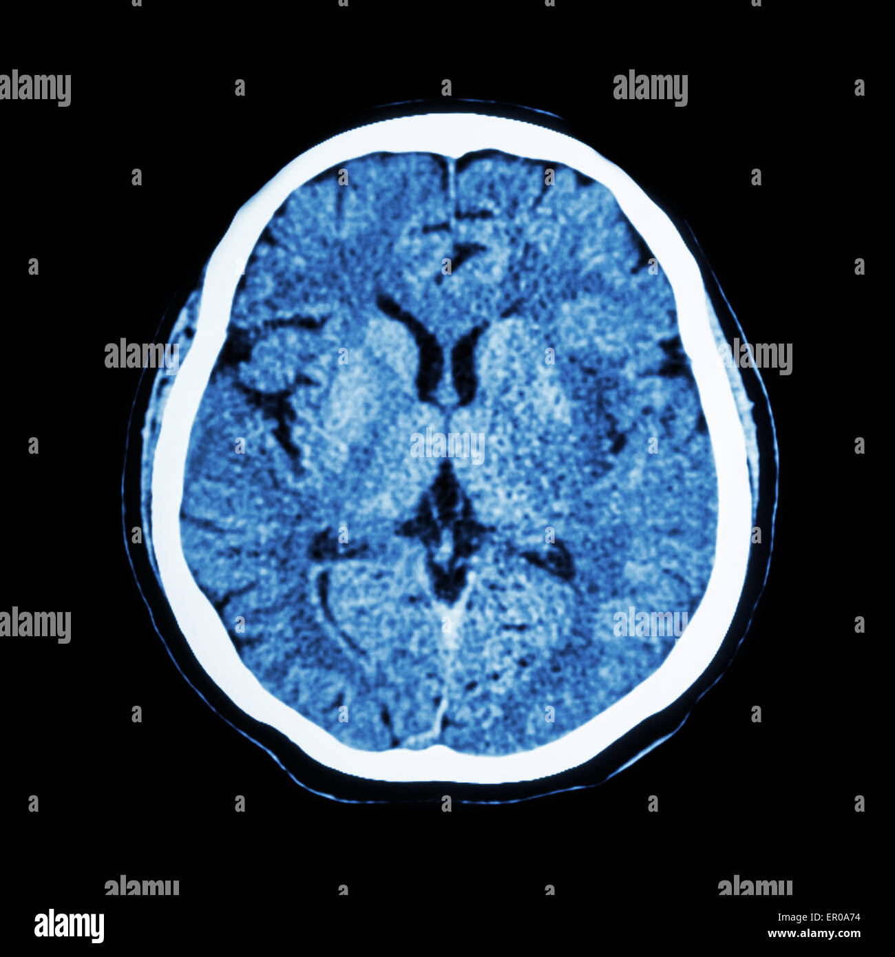 CT-Scan des Gehirns: zeigen normale menschliche Gehirn (CAT-Scan) Stockfoto
