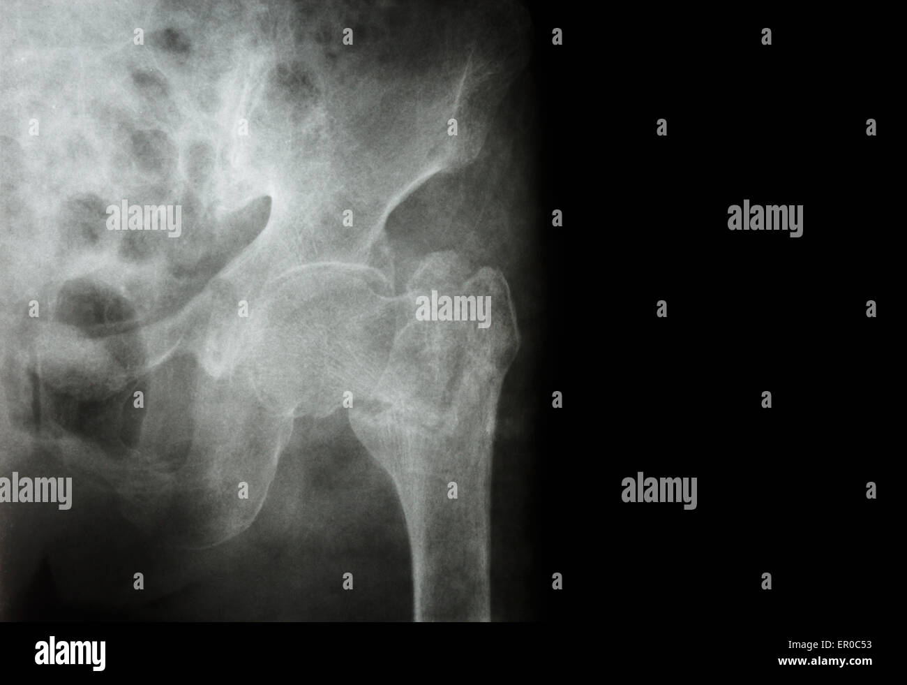 intertrochanteric (Hals des Femur) Bruch linken Femur (Oberschenkelknochen) und leeren Bereich auf der rechten Seite Stockfoto