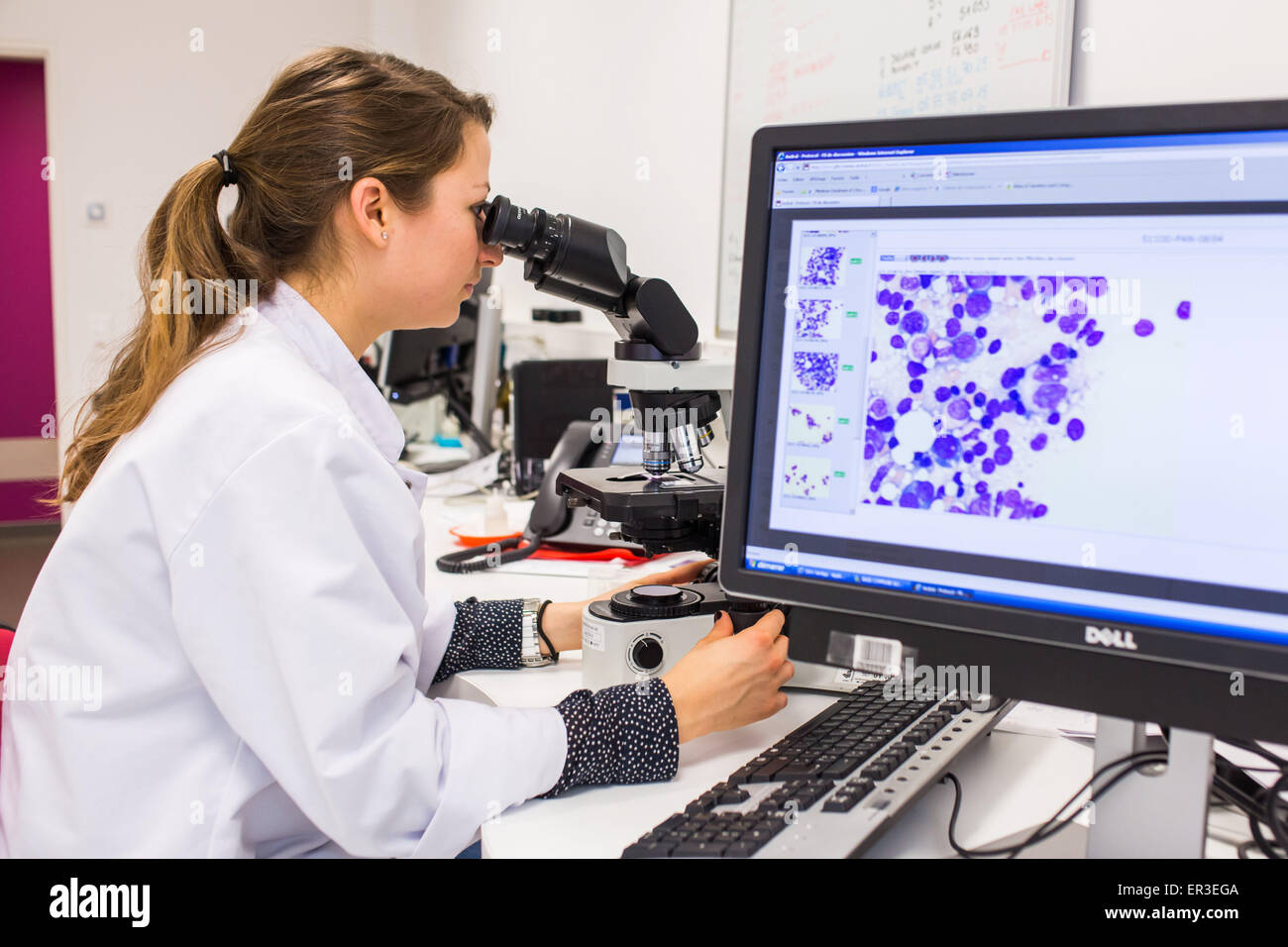 Beobachtung einer Knochenmark-Abstriche (Myelogramm) für die Diagnose von Krebs Hämatologie. Labor-Hämatologie-Zytologie. Biologie und Research Center (CBR) des Krankenhauses Limoges, Frankreich. Stockfoto