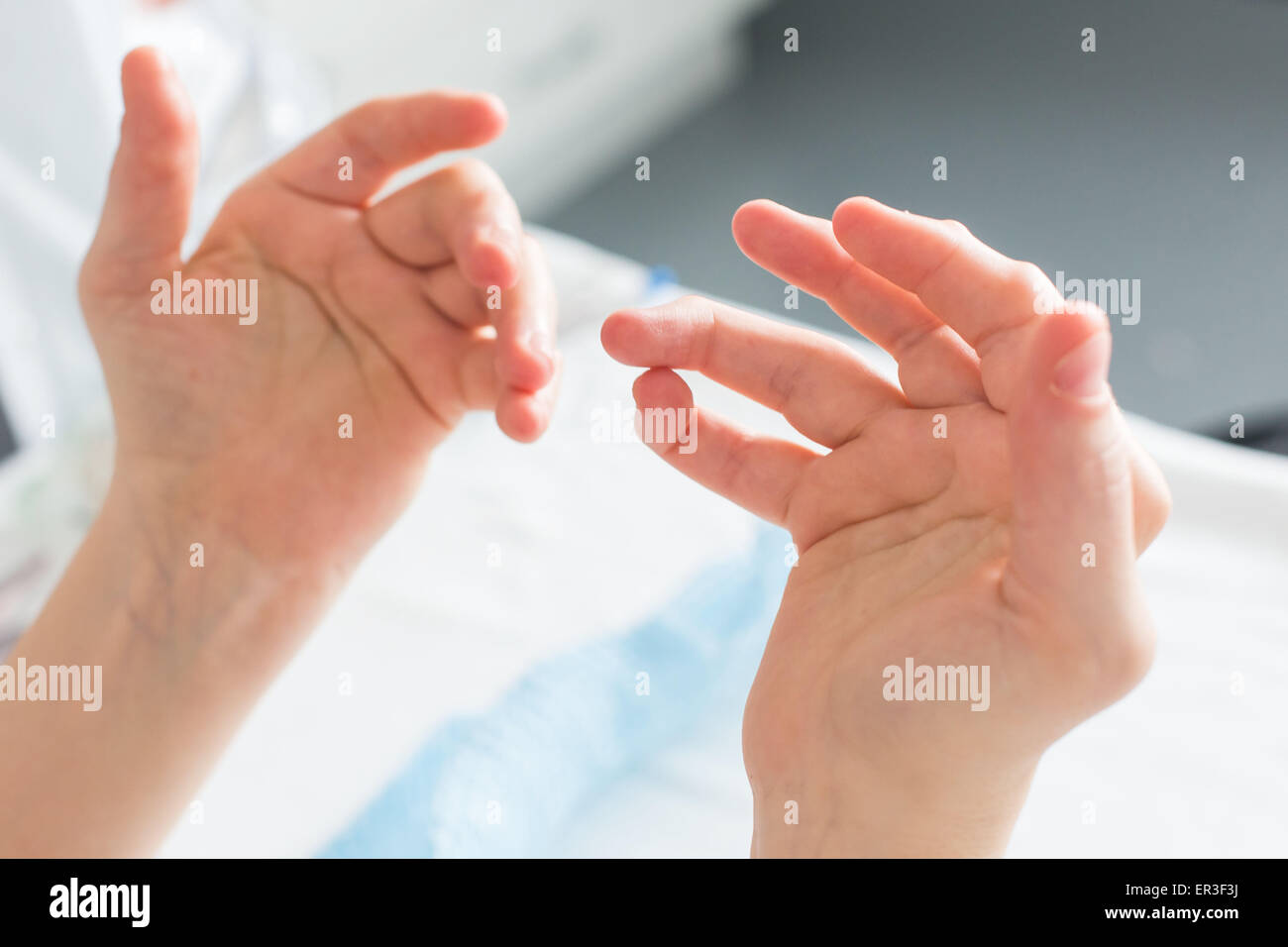 Hände einer Frau mit rheumatoider Arthritis. Stockfoto