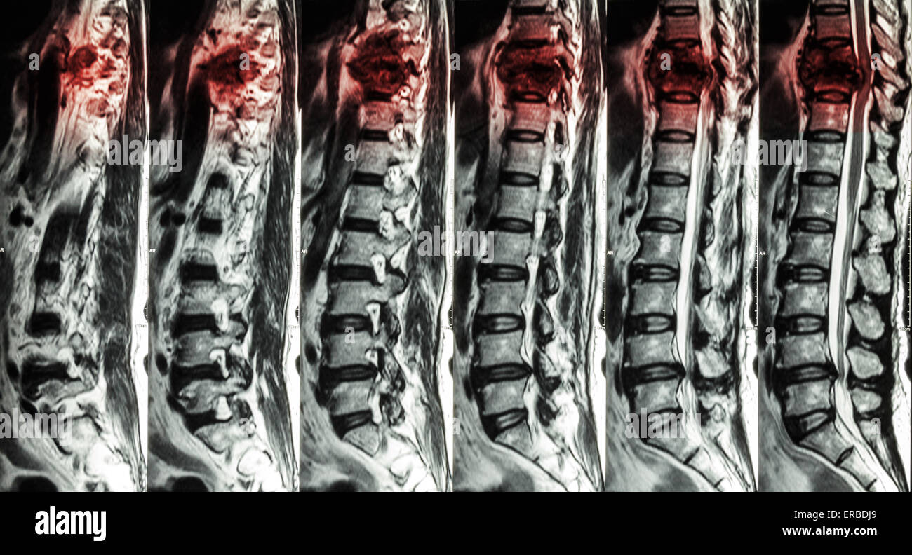 MRT der Lendenwirbelsäule & Brustwirbelsäule: Bruch der Brustwirbelsäule zeigen und komprimieren Rückenmark (Myelopathie) Stockfoto