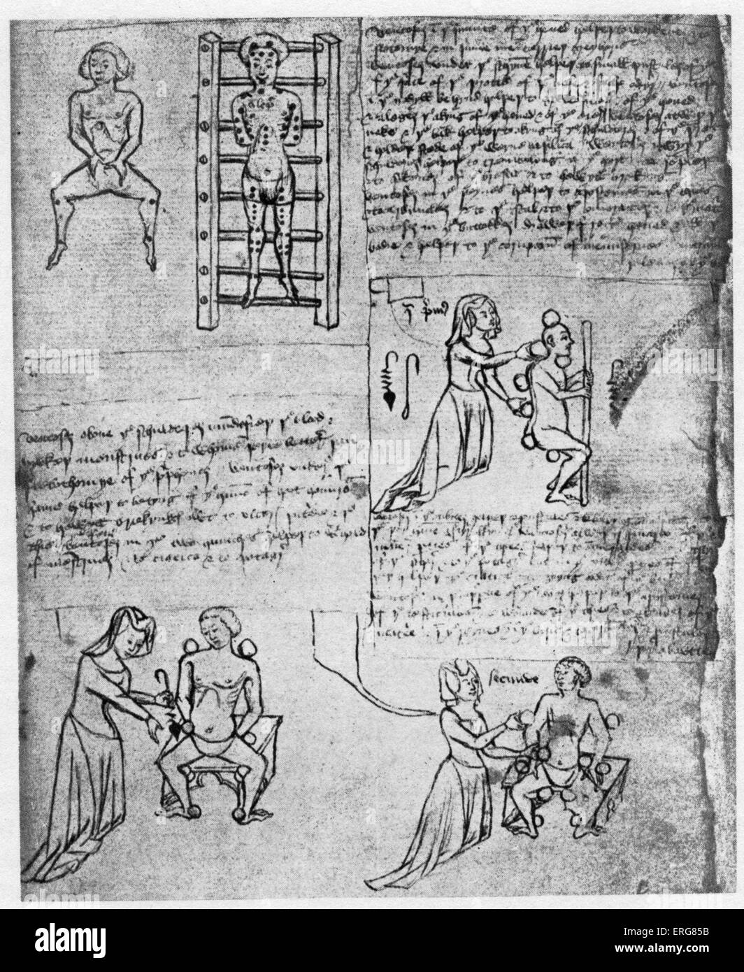 Mittelalterliche chirurgische Behandlung.  Illustrationen von John Arderne Abhandlung.  14. Jahrhundert. Stockfoto