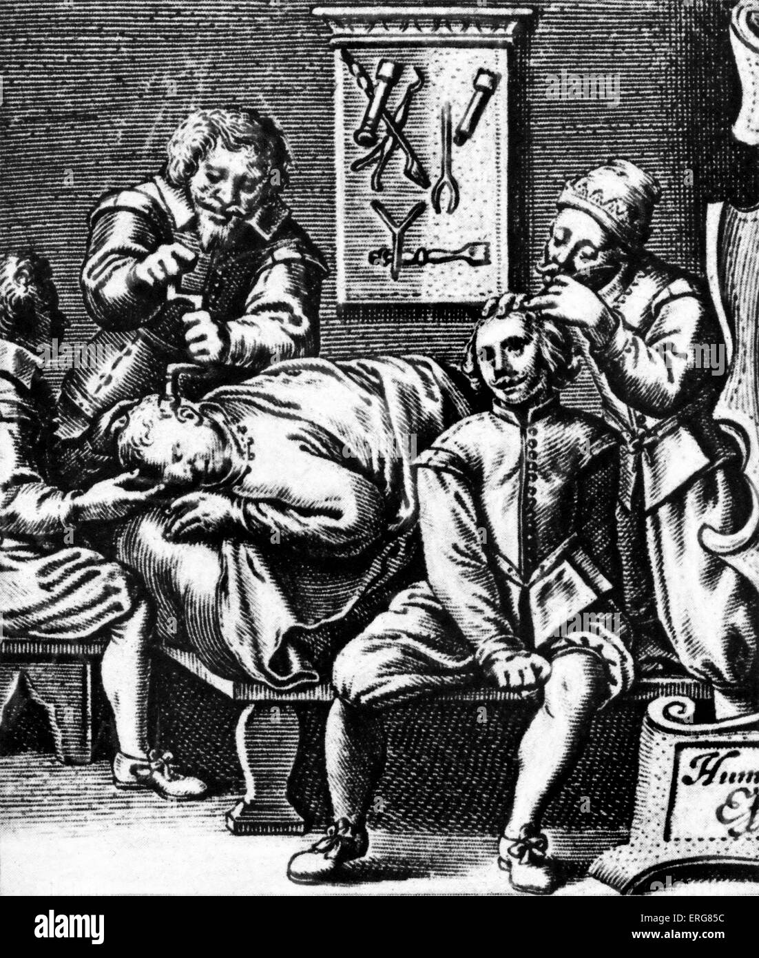 Medizinischen Eingriff im 17. Jahrhundert. Von Ambroise Parés übersetzten "arbeitet" 1649. Stockfoto