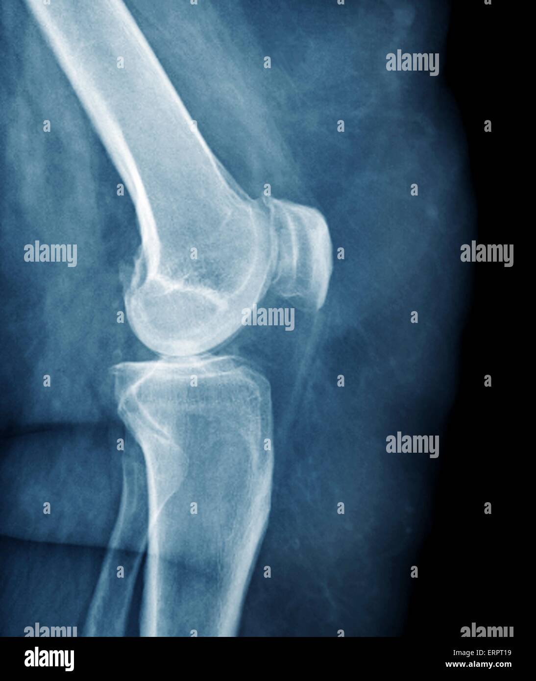 Farbige Profil Röntgen zeigt das linke Knie eines 46 Jahre alten adipösen Patienten mit Arthritis. Stockfoto