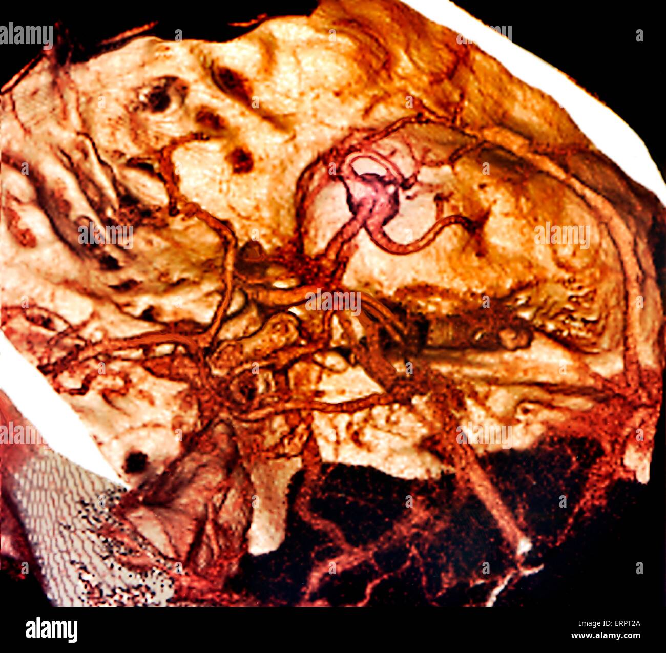 Hirnblutung. Farbige 3D CT (Computertomographie) Angio-Scan des Gehirns eine 42 jährige Patientin mit eine subarachnoidale Blutung (SAH, heller Bereich obere Mitte-rechts). SAH blutet in den Subarachnoidalraum - das Gebiet zwischen der Arachnoidea mem Stockfoto