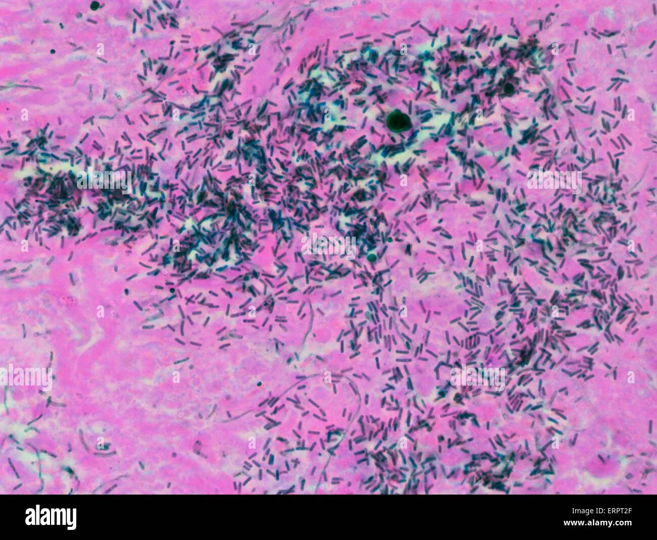 Ulcerosa. Leichte Schliffbild (LM) eines Teils der bakteriellen Invasion des menschlichen Darms Wand. Colitis ist eine lebensbedrohliche Komplikation der aplastischen Anämie, die in Zeiten der tiefen Neutropenie (eine niedrige Neutrophilen Leukozytenzahl) auftritt, wodurch Stockfoto