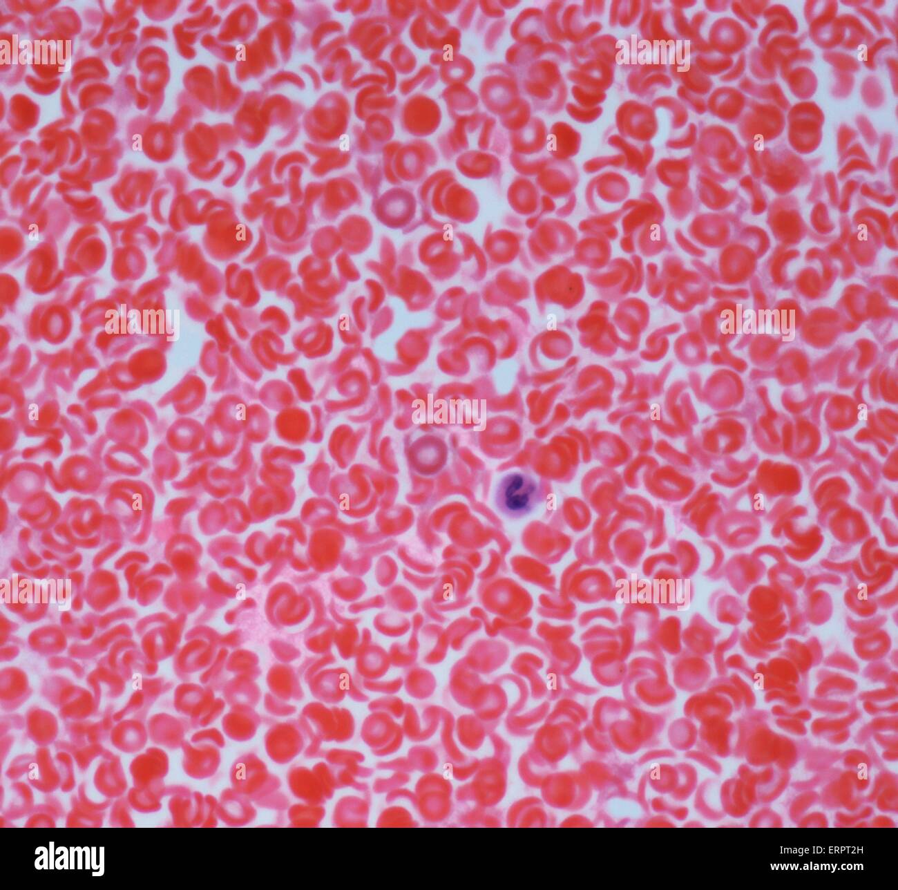 Blut. Leichte Schliffbild der roten Blutkörperchen (Erythrozyten, rot) in einem Blutgefäß. Eine weiße Zelle ist sichtbar (Mitte). Vergrößerung: X500 wenn bei 10 cm breite gedruckt. Stockfoto