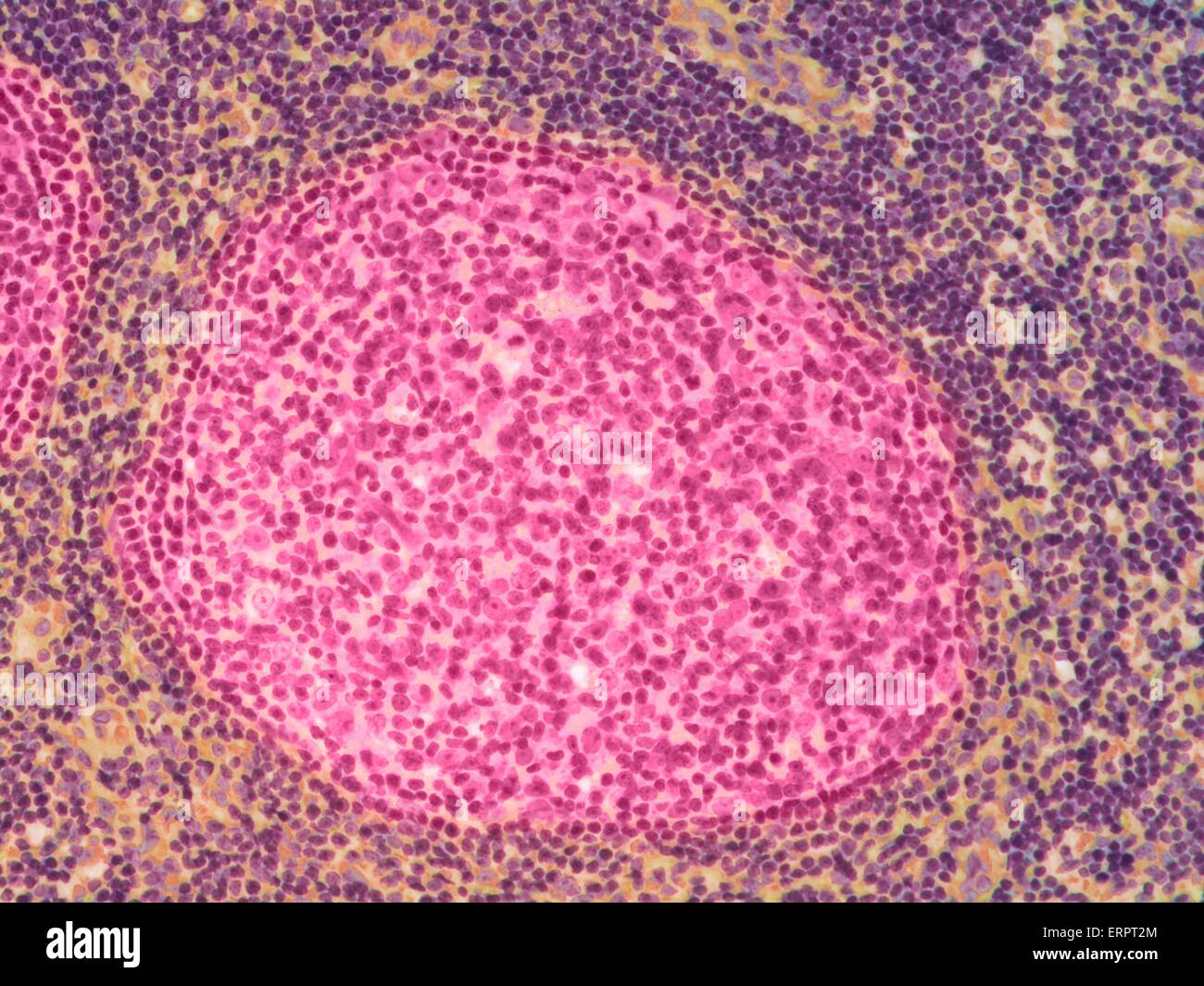 Lymphknoten. Farbiges Licht Schliffbild eines Abschnitts durch einen Lymphknoten. Ein Lymphknoten filtert Krankheitserreger von Lymphflüssigkeit, eine wässrige Flüssigkeit, die die Gewebe des Körpers umgibt. Das germinal Zentrum des Knotens (rosa) beherbergt B-Lymphozyten (eine Art von weißen Stockfoto