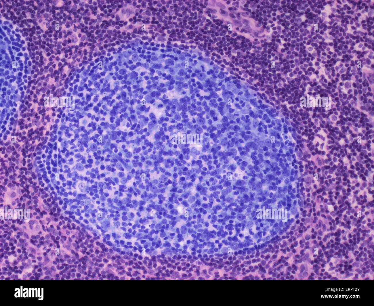 Lymphknoten. Farbiges Licht Schliffbild eines Abschnitts durch einen Lymphknoten. Ein Lymphknoten filtert Krankheitserreger von Lymphflüssigkeit, eine wässrige Flüssigkeit, die die Gewebe des Körpers umgibt. Die germinal Zentrum des Knotens (blau) gibt es B-Lymphozyten (eine Art von weißen Stockfoto