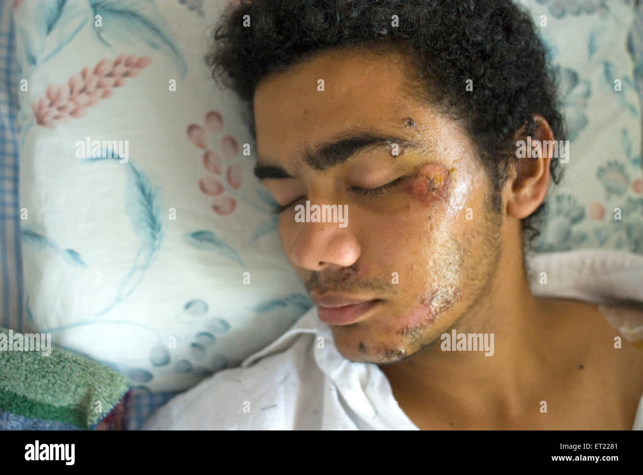 Jungen Mann mit zwölf Stichen im Gesicht schlafen im Krankenhaus verletzt; Thane; Maharashtra; Indien Herr #711 Stockfoto