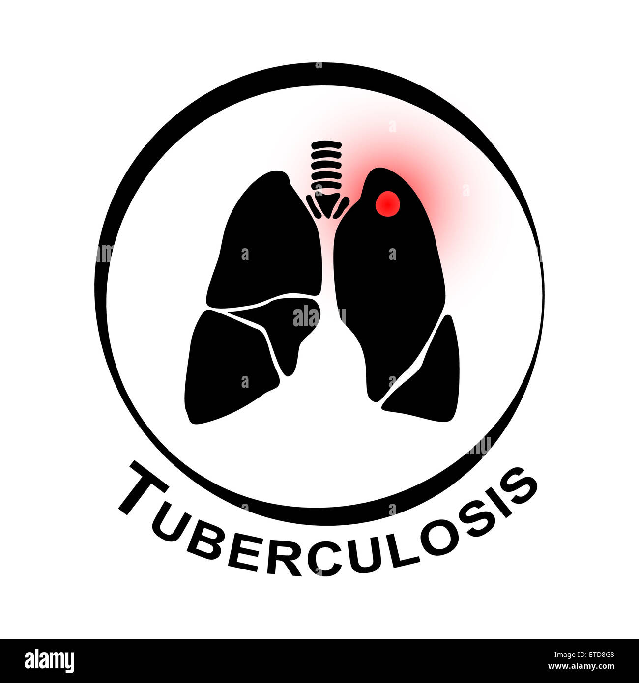 Pulmonale Tuberkulose-Symbol (Lunge mit Hohlraum am linken Oberlappens durch Mycobacterium Tuberculosis Infektion) Stockfoto