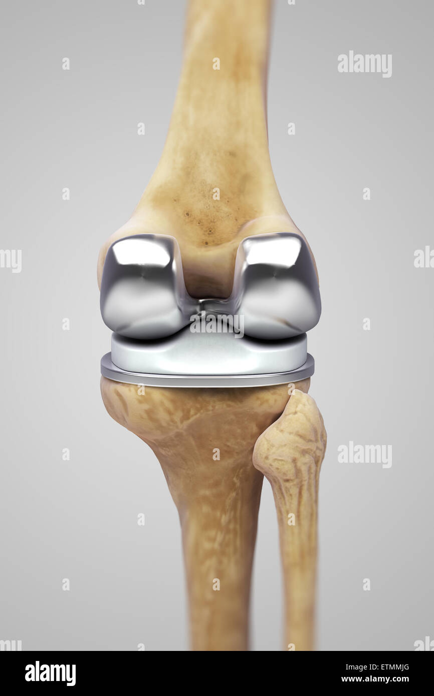 Darstellung einer Knie-Totalprothese. Stockfoto