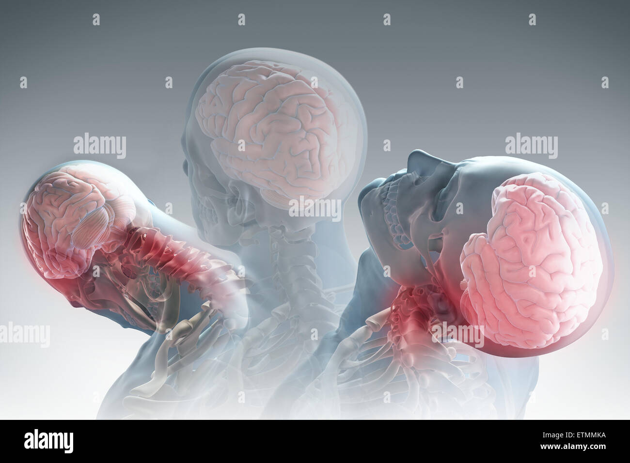 Konzeptionelle Darstellung der Phasen der Bewegung dieser Ursache Schleudertrauma: Rückzug, Erweiterung und Erholung. Stockfoto