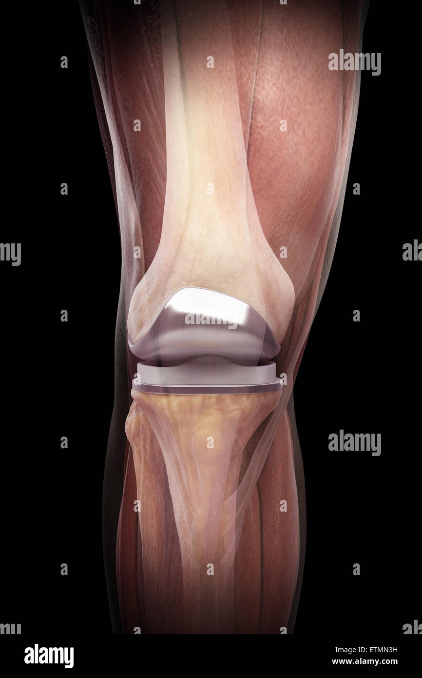 Darstellung einer Knie-Totalprothese mit transparenten Muskel. Stockfoto