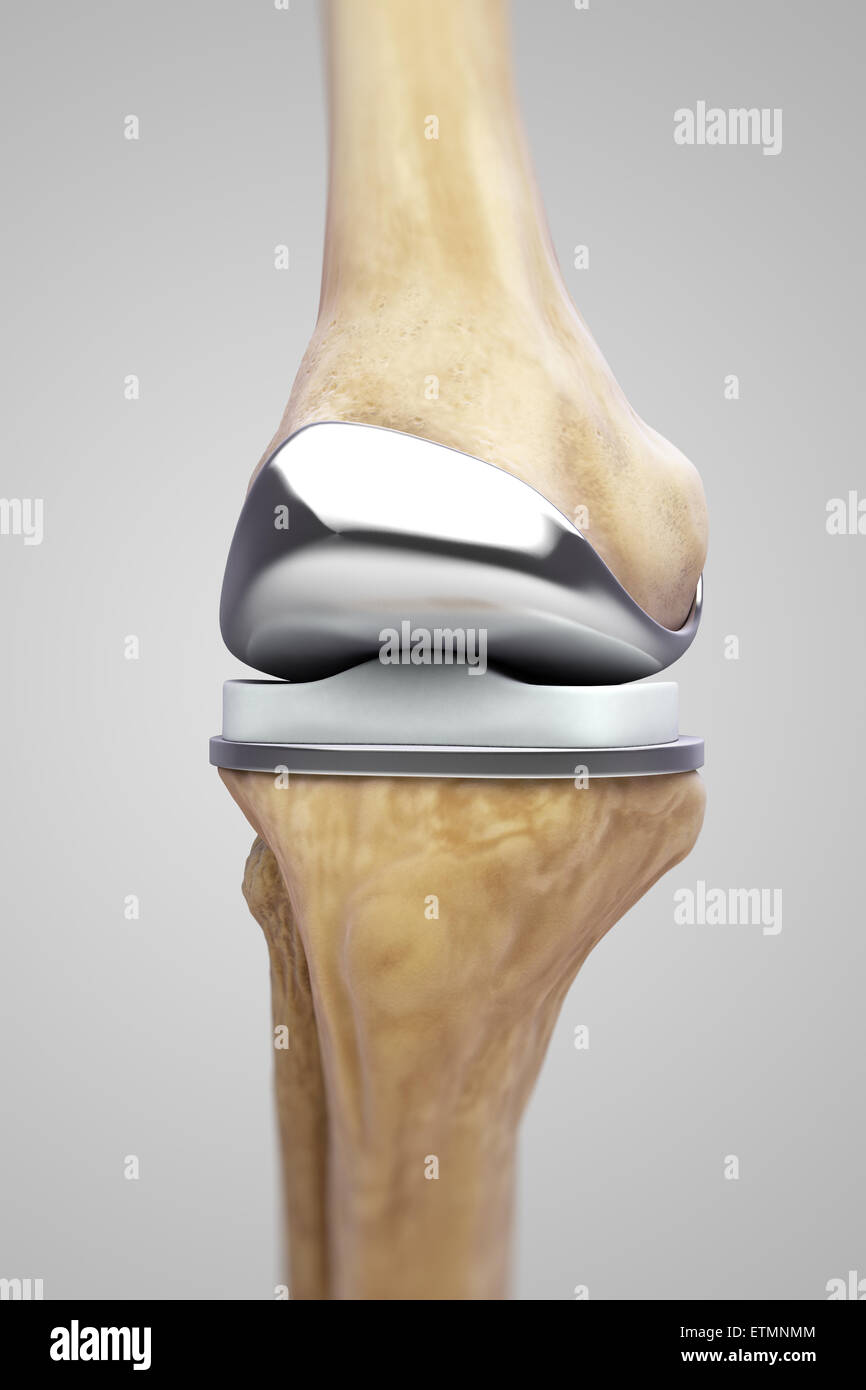 Darstellung einer Knie-Totalprothese. Stockfoto