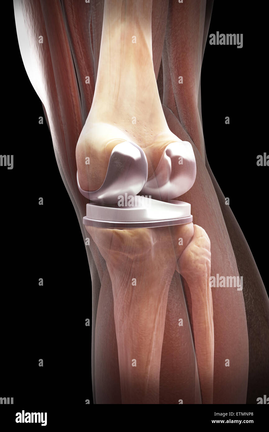 Darstellung einer Knie-Totalprothese mit transparenten Muskel. Stockfoto