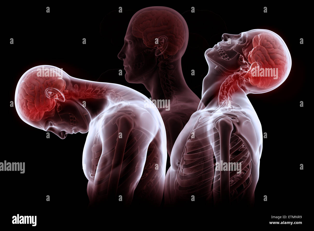 Konzeptionelle Darstellung der Phasen der Bewegung dieser Ursache Schleudertrauma: Rückzug, Erweiterung und Erholung. Stockfoto