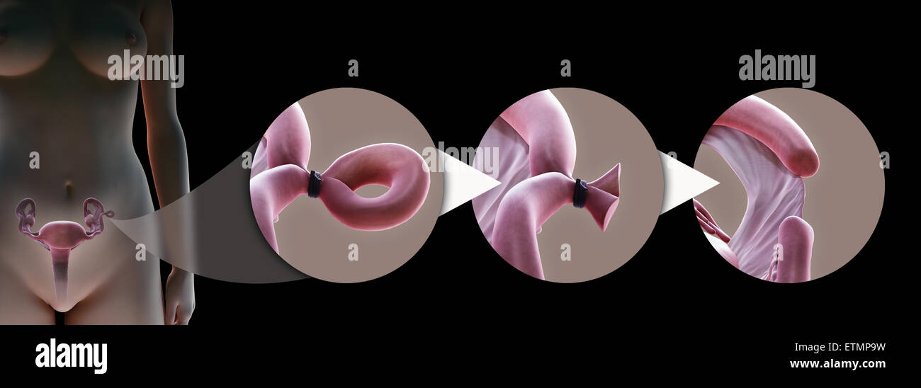 Darstellung, Tubal Verbindung des Eileiters durch Pomeroy-Methode, die einen Abschnitt des Rohres zu verhindern, dass die Befruchtung entfernt. Stockfoto