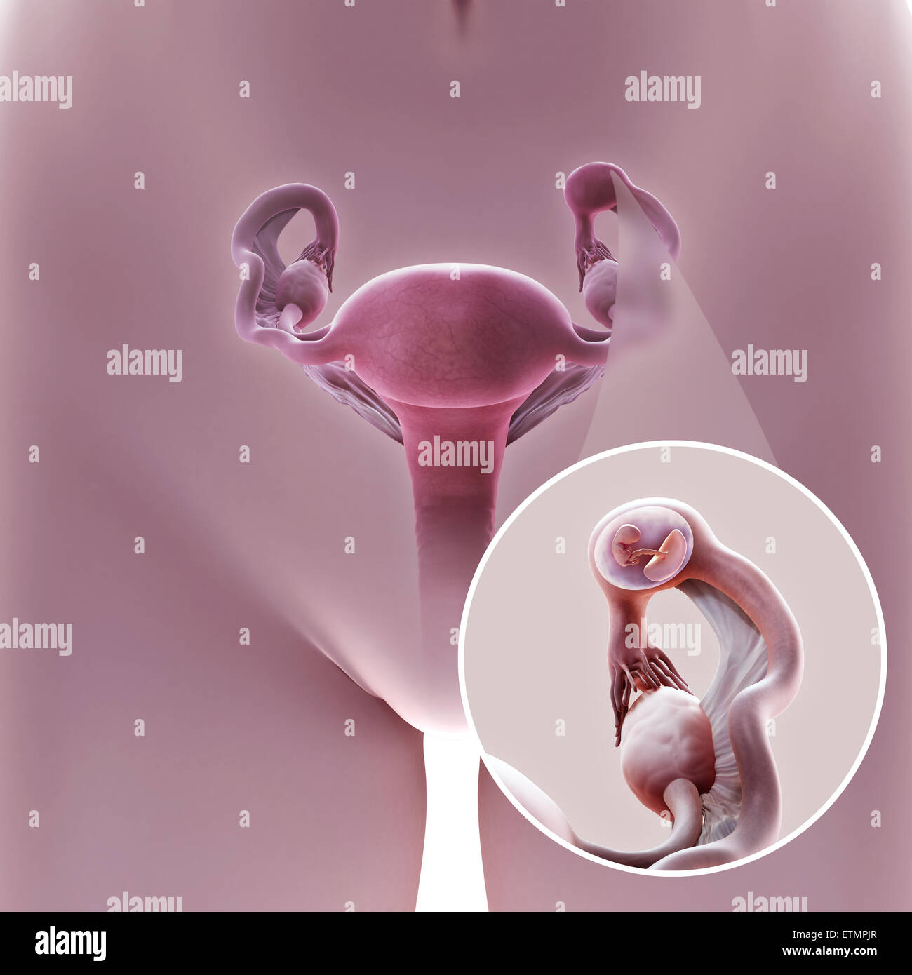 Darstellung der weiblichen Reproduktion System während einer Eileiterschwangerschaft Lage im Abschnitt Ampulle des Eileiters, zeigt ein verkleinerte Abschnitt des Embryos. Stockfoto