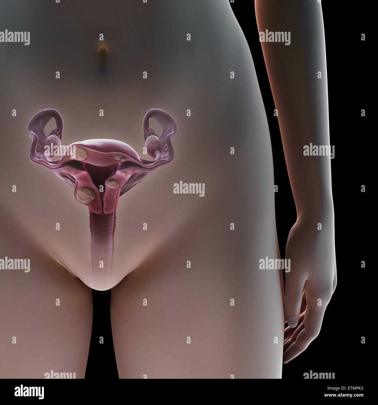 Querschnitt-Darstellung, die Myome, gutartige Tumore in der Gebärmutter. Stockfoto