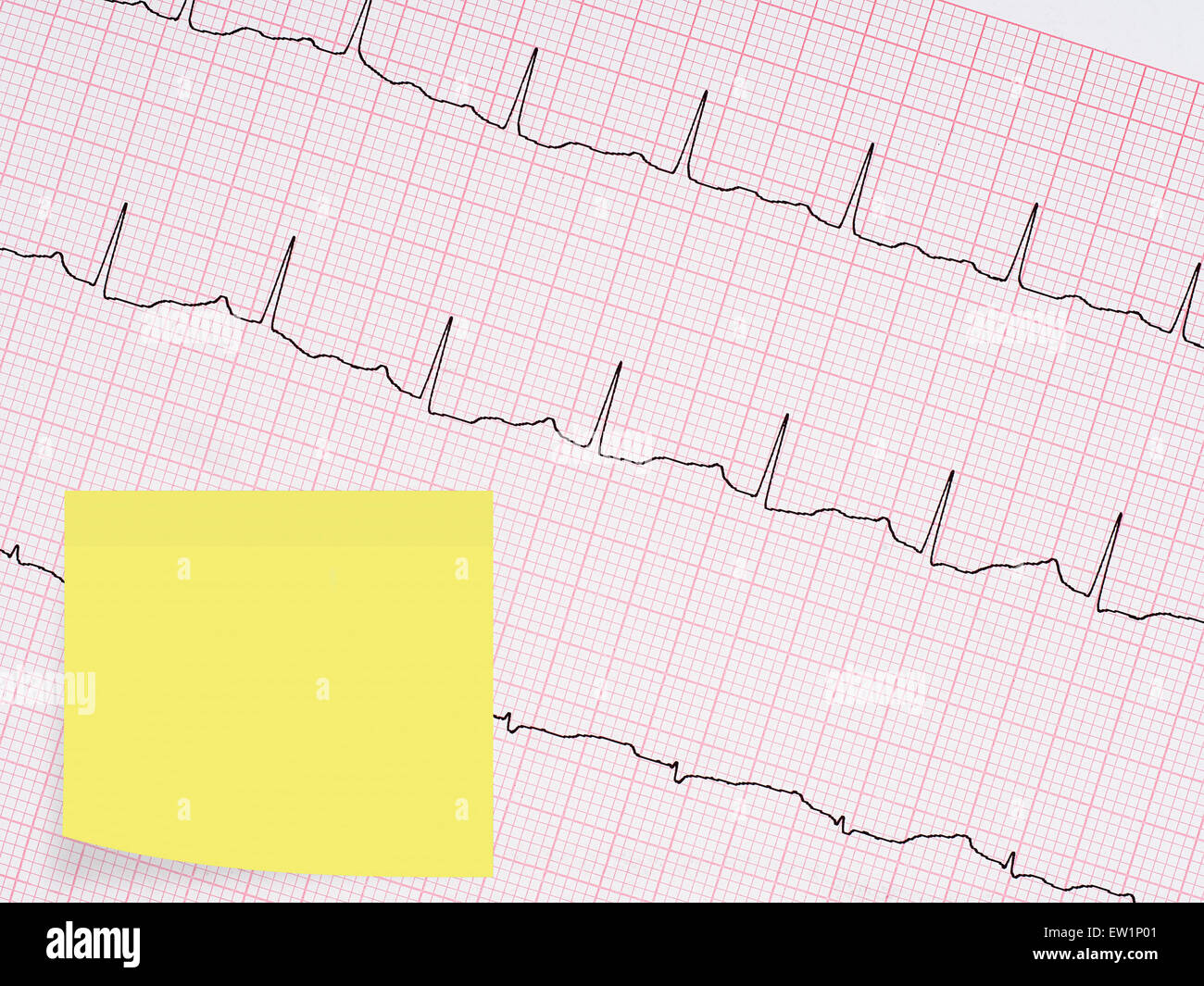 Gesundes Herz etc.. Elektrokardiogramm EKG Ausdruck Detail mit Hinweis für Ihre Gesundheit-Nachricht. Stockfoto