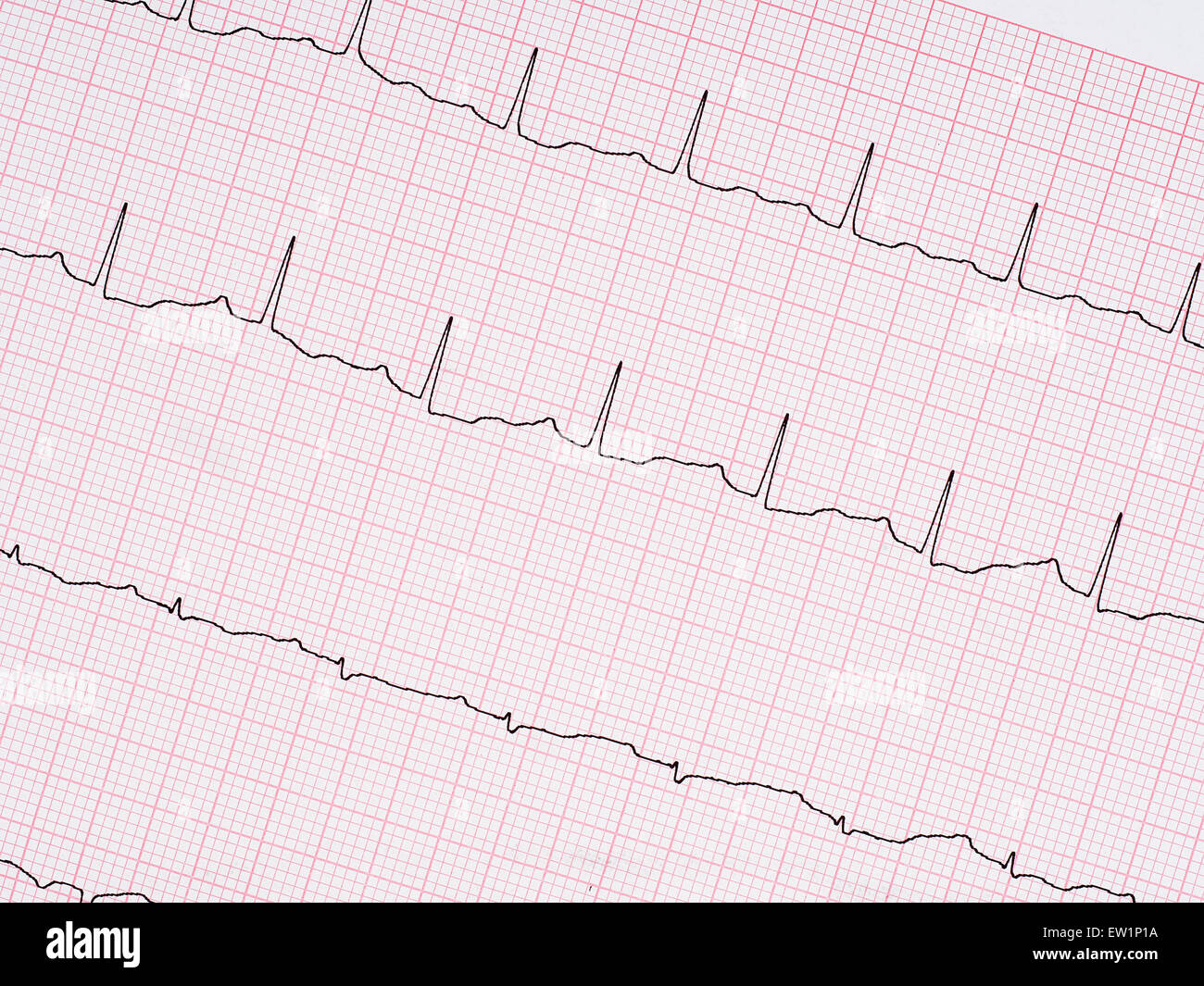 Gesundes Herz etc.. Echte Elektrokardiogramm EKG Ausdruck Detail. Stockfoto