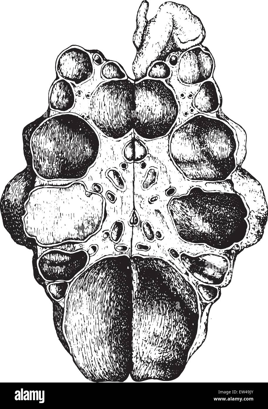 Niere, kongenitale zystische Erkrankung, offen, gelegt Vintage Illustration eingraviert. Stock Vektor