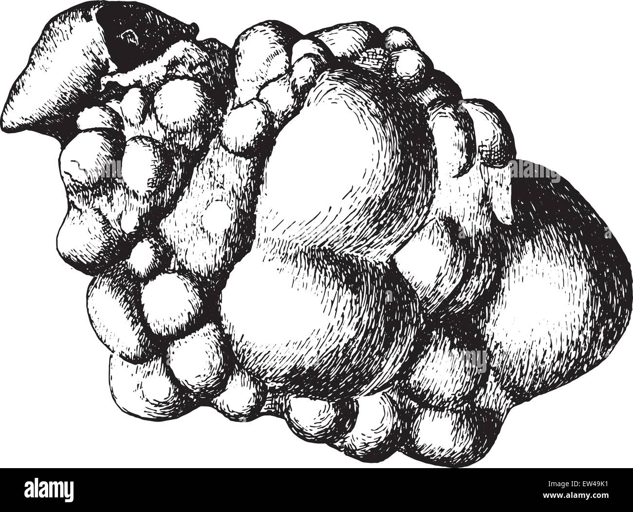 Niere, kongenitale zystische Erkrankung, offen, gelegt Vintage Illustration eingraviert. Stock Vektor