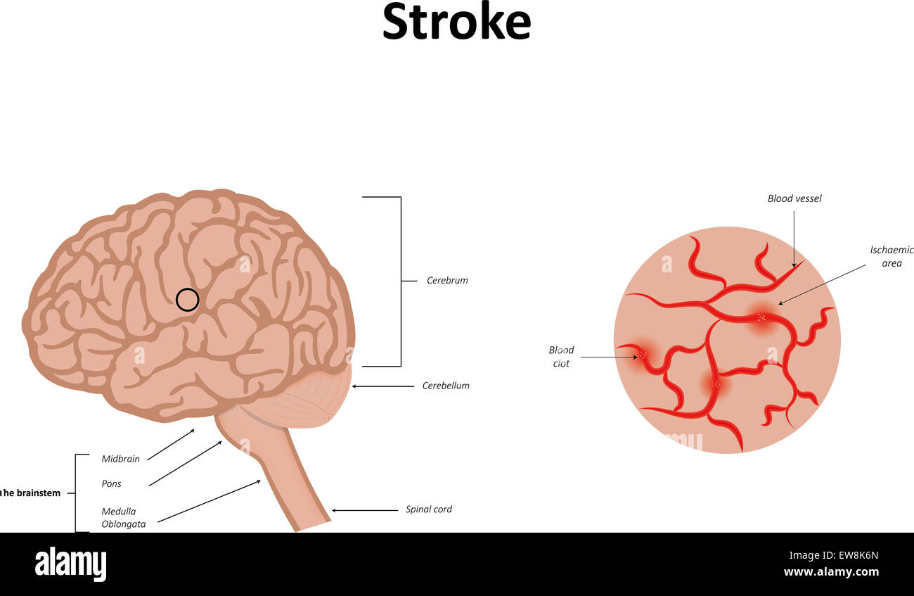 Мозг человека без кислорода. What is stroke. Strokes is. On the stroke of. Brain stroke illustration.
