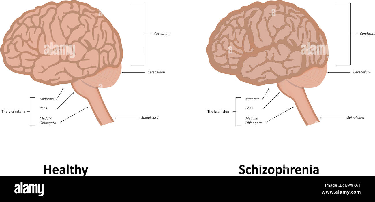 Schizophrenie Stockfoto