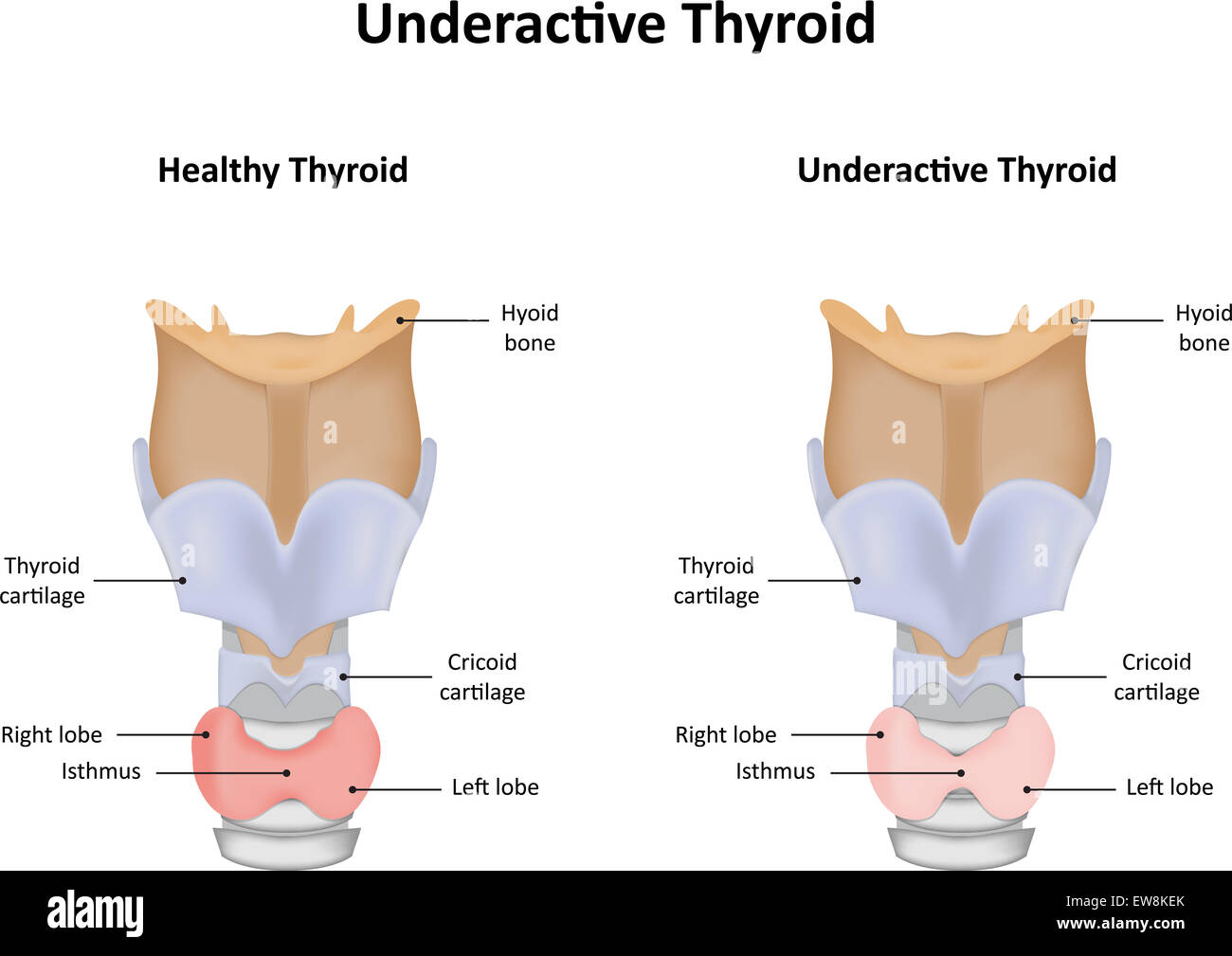 Hypothyreose Fotos und Bildmaterial in hoher Auflösung Alamy