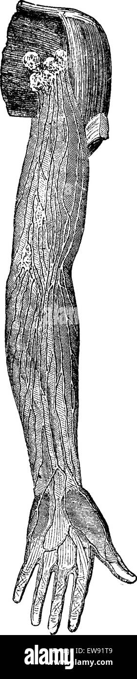 Oberflächlichen Lymphgefäße der oberen Extremität, graviert Vintage Illustration. Üblichen Medizin Wörterbuch - Paul Labarthe - 1885 Stock Vektor