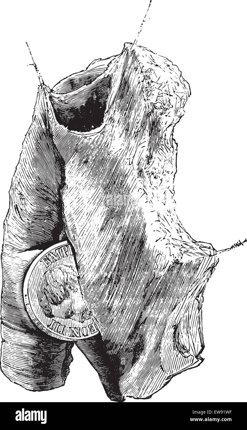 Fremdkörper in der Speiseröhre, graviert Vintage Illustration. Üblichen Medizin Wörterbuch - Paul Labarthe - 1885. Stock Vektor