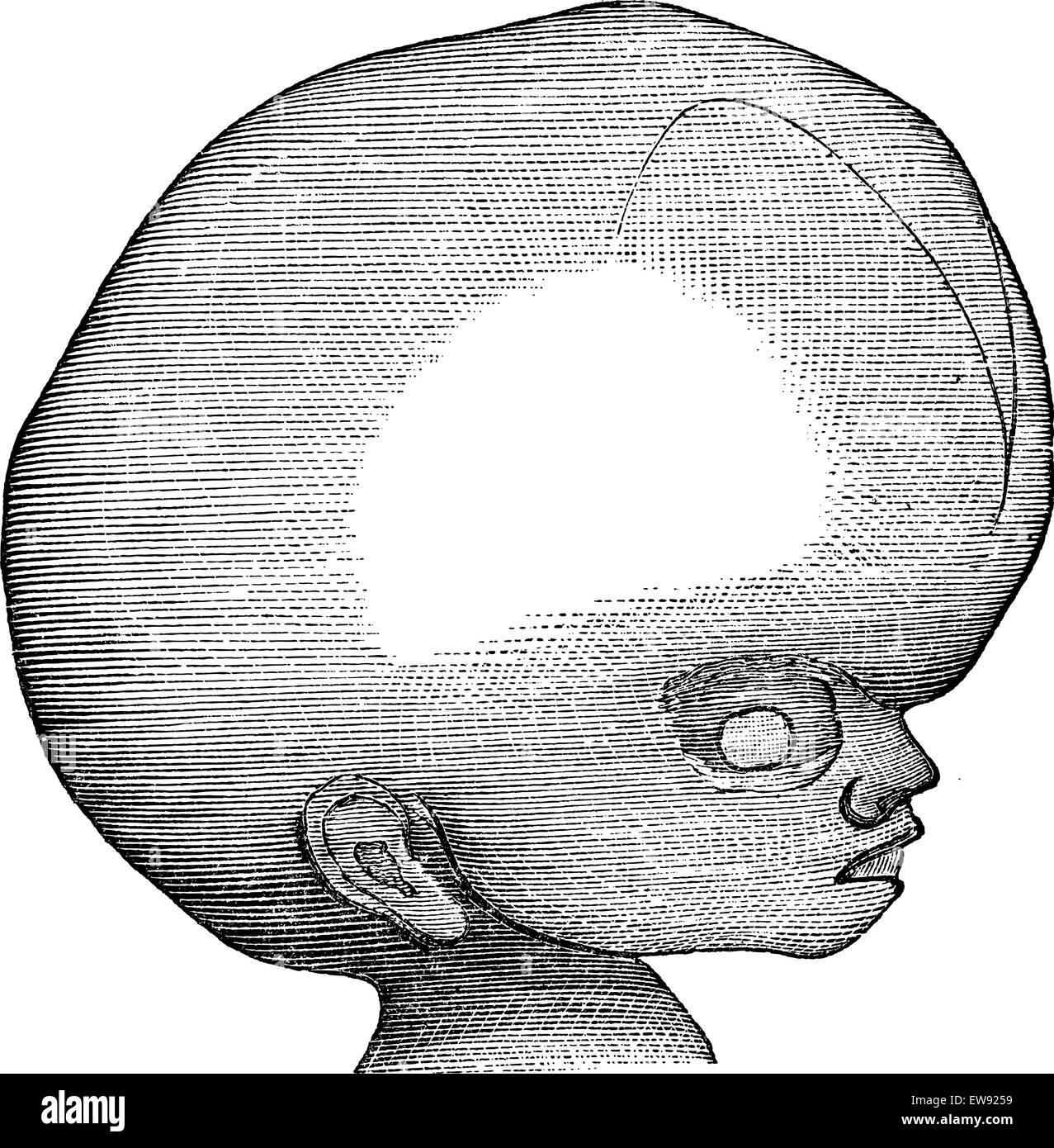 Hydrocephalus, graviert Vintage Illustration. Magasin Pittoresque 1875. Stock Vektor